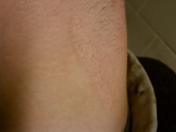 burn scar