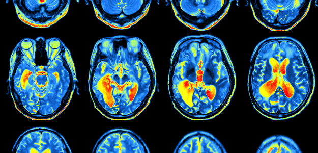 brain-scan-ADHD