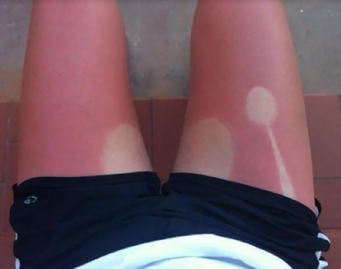Funny sunburn