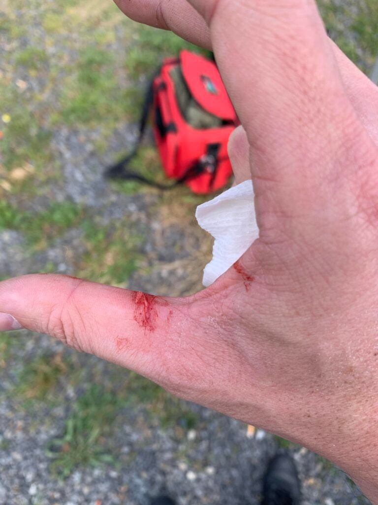 Slide bite injury