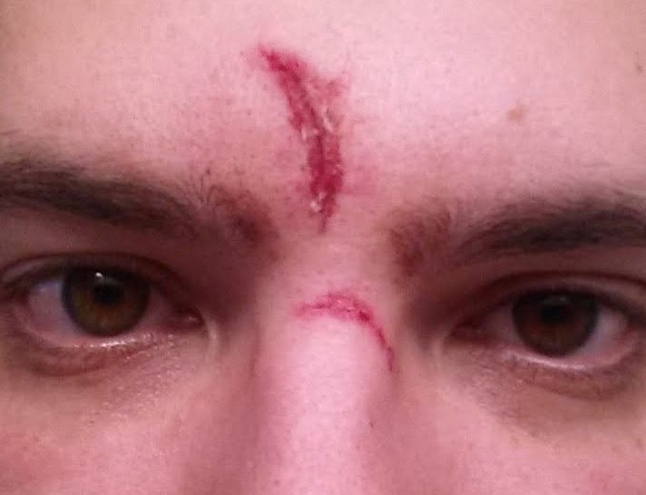 Scope Bite